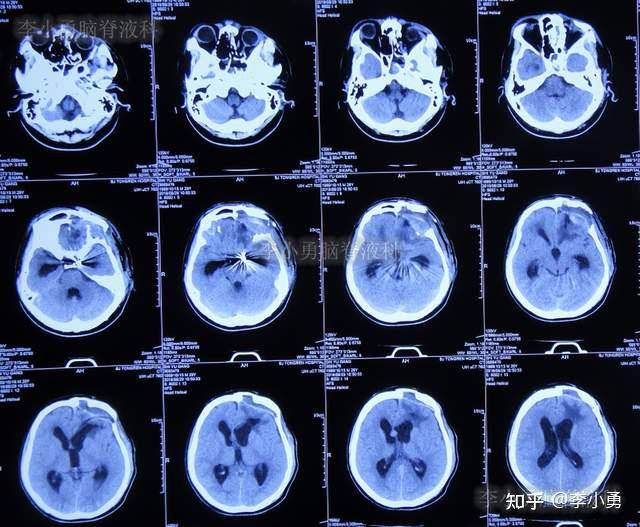 腦外傷後腦脊液鼻漏顱內動脈瘤栓塞術後和開顱術腦脊