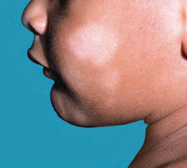 白癜风与白色糠疹的区别