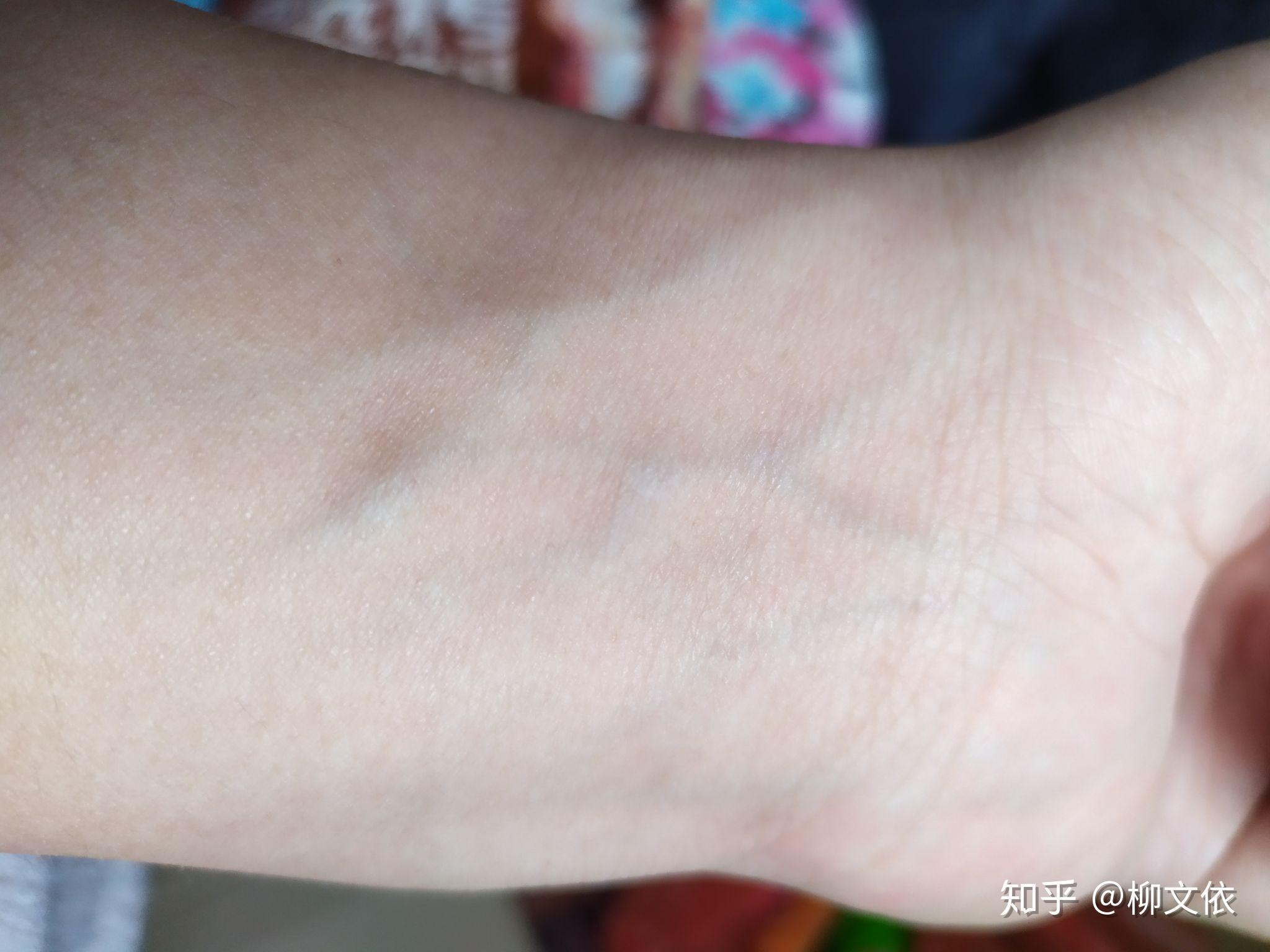 手腕上静脉颜色很明显是身体有什么病症的原因吗