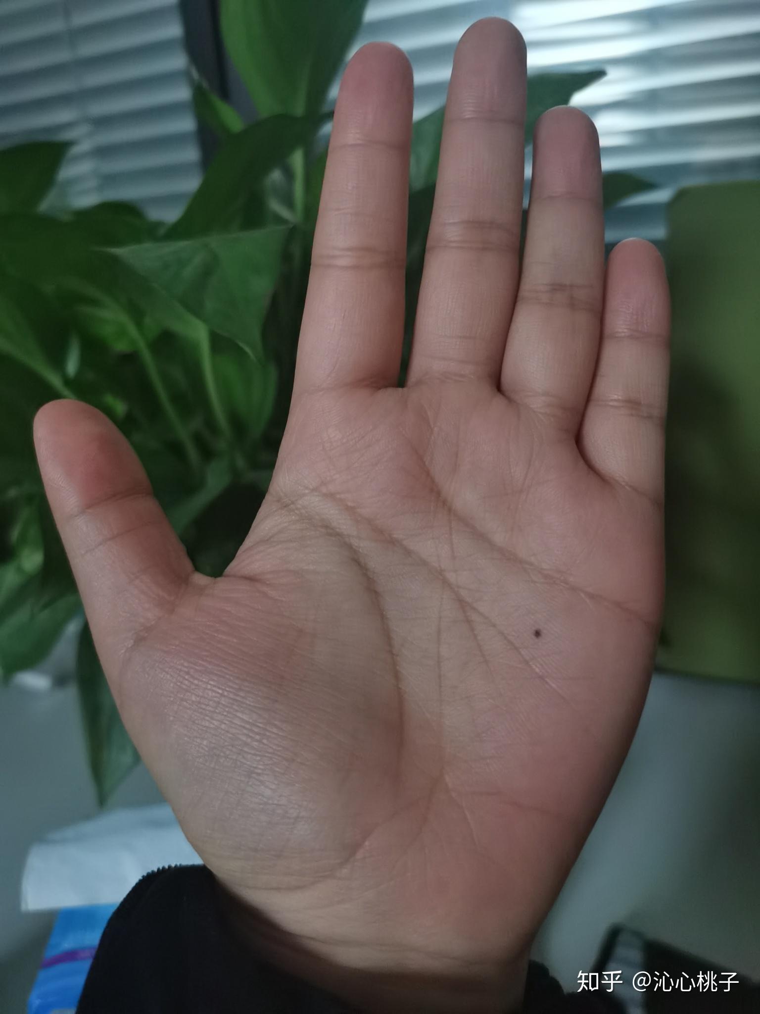 手心里突然长了一颗小痣代表什么? - 知乎