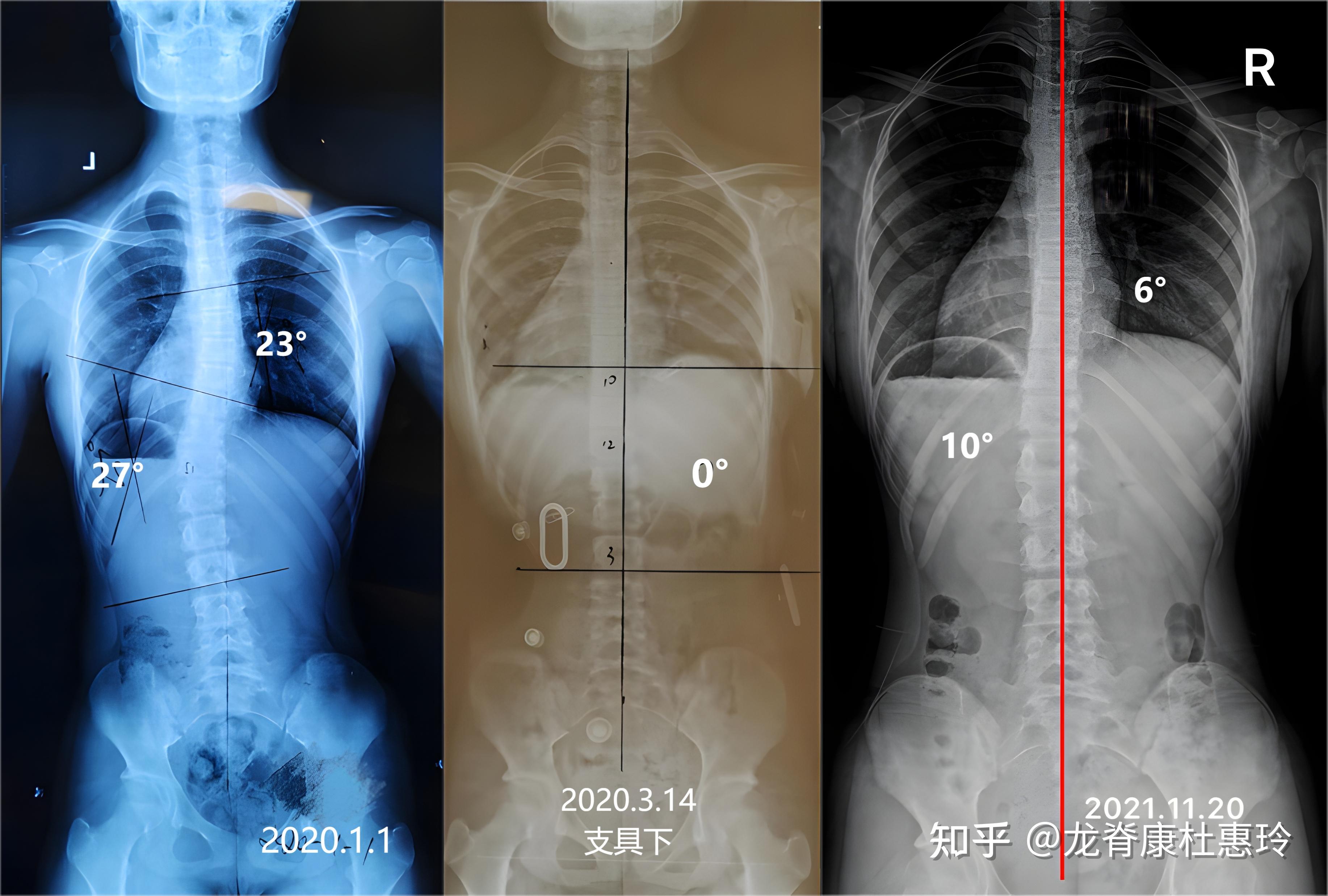 3.特发性脊柱侧凸的前路手术-外科主治医师-医学