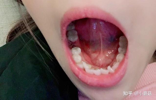 第一次种植牙经历简直一言难尽