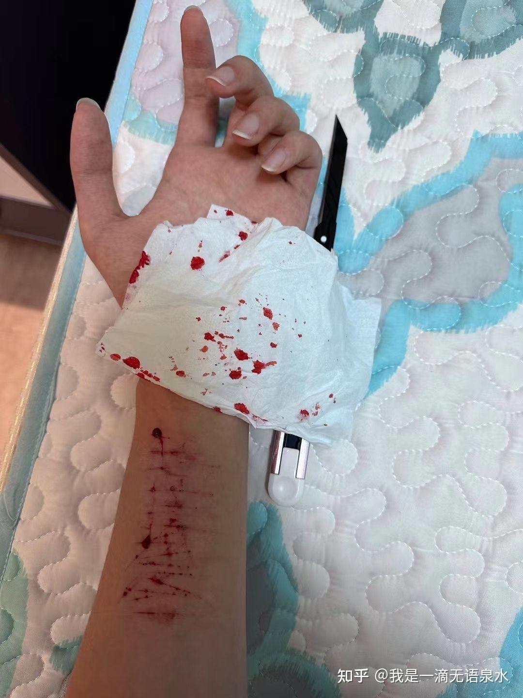 手腕上有自残的粑,需要除,但又不敢跟家长说怎么办?