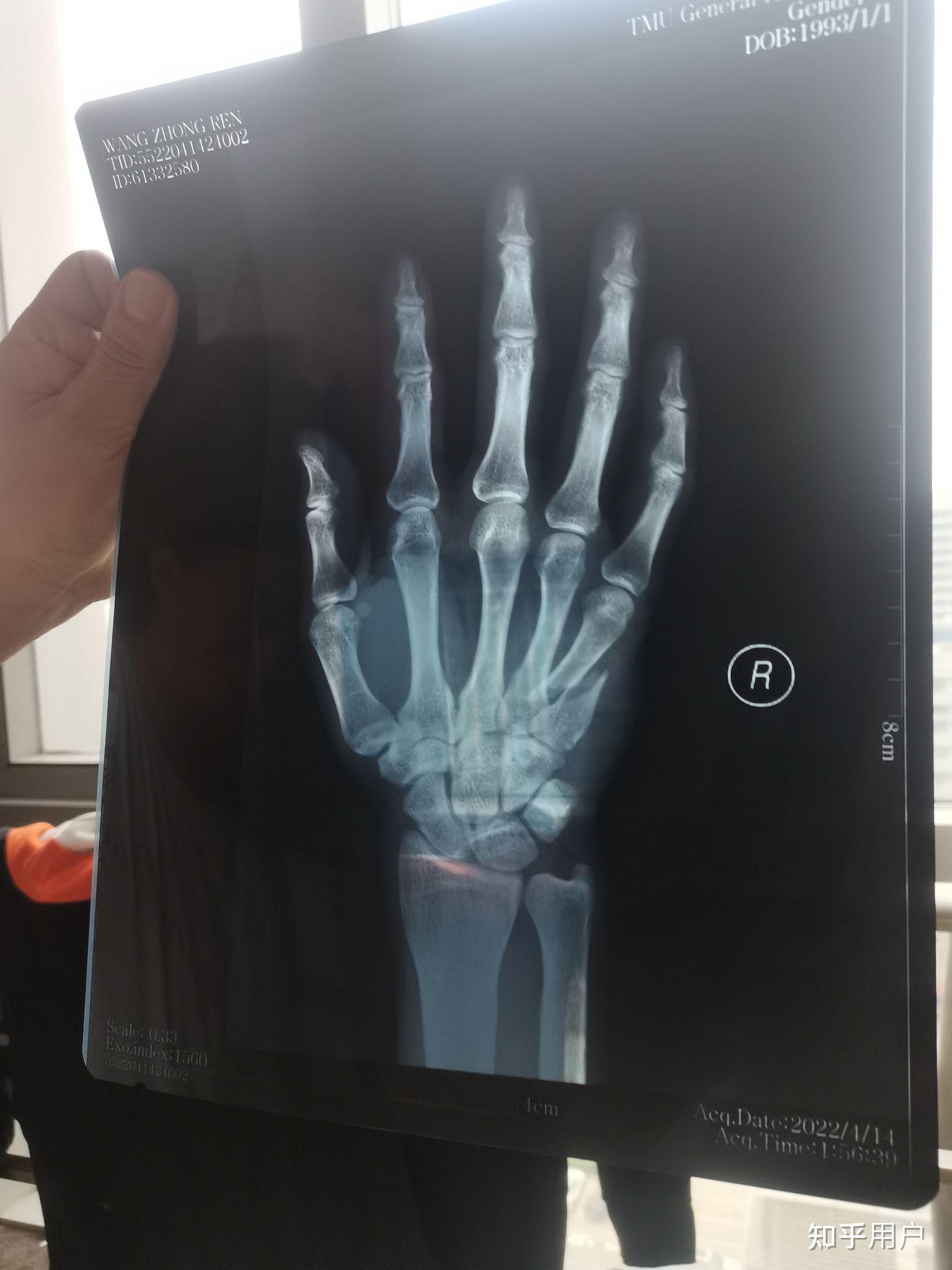 手掌骨折x光图片