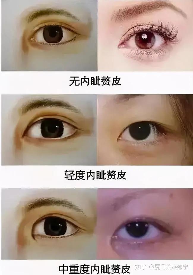 厦门割双眼皮你需要开眼角吗来了解下