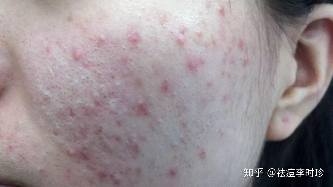 不同程度的痘痘护理要点,你是哪一程度呢? - 知乎