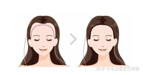发际线多高算正常