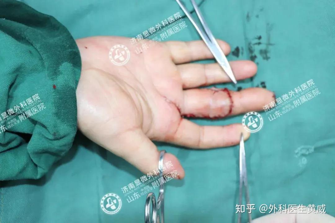 手指缺损患者慕名而来3d全形手指再造技术到底有好