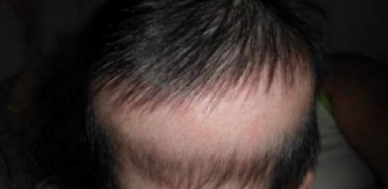 2个月宝宝掉头发正常吗? - 知乎