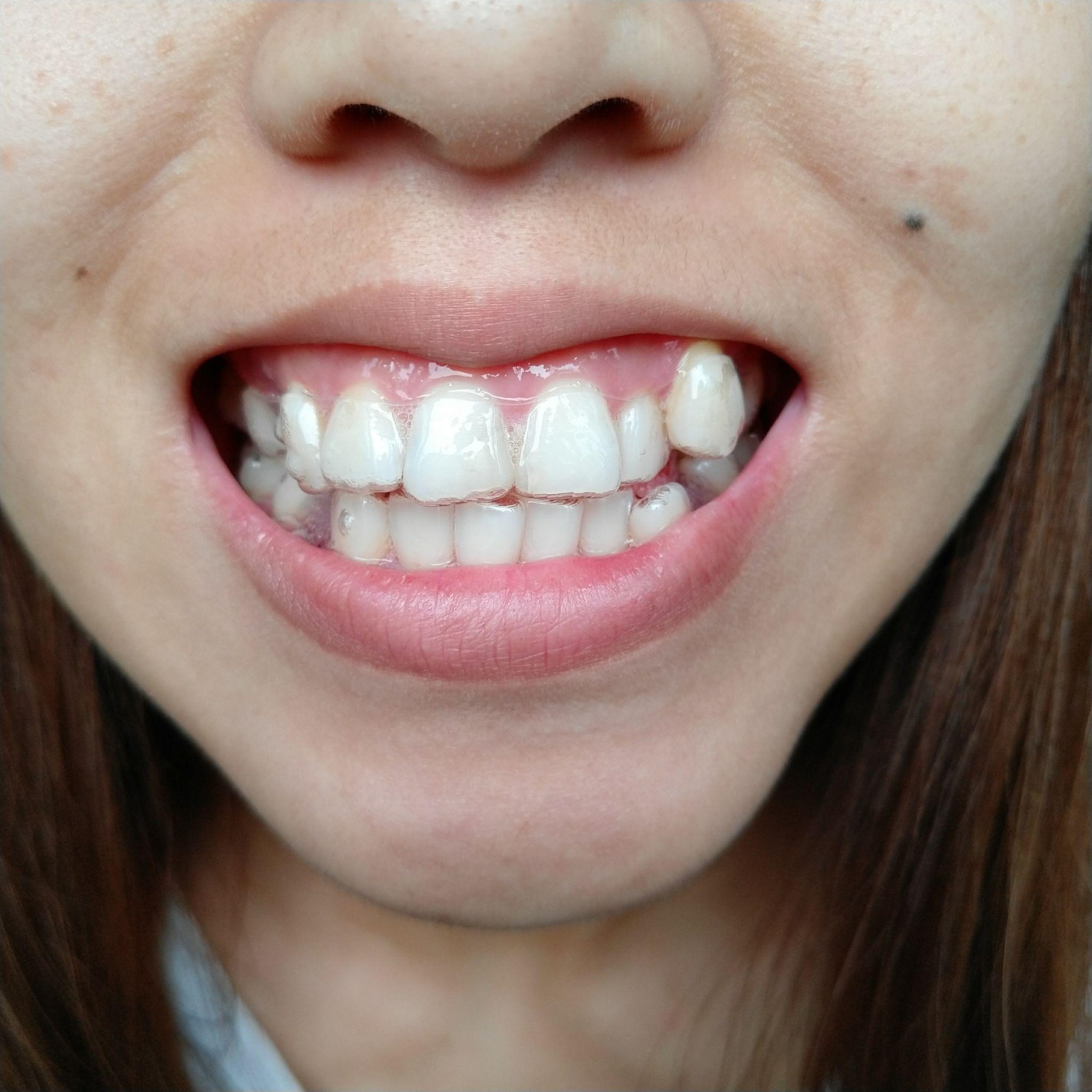 肉全没了感觉牙套脸都要出来了脸颊两侧有个小凹陷的阴影医生都吓到了