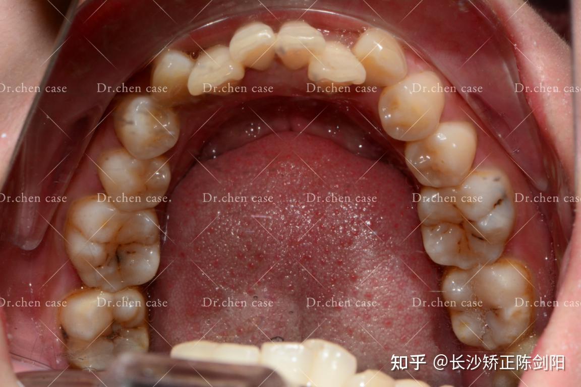 深覆盖会引起下巴后缩吗?在长沙能矫正吗?