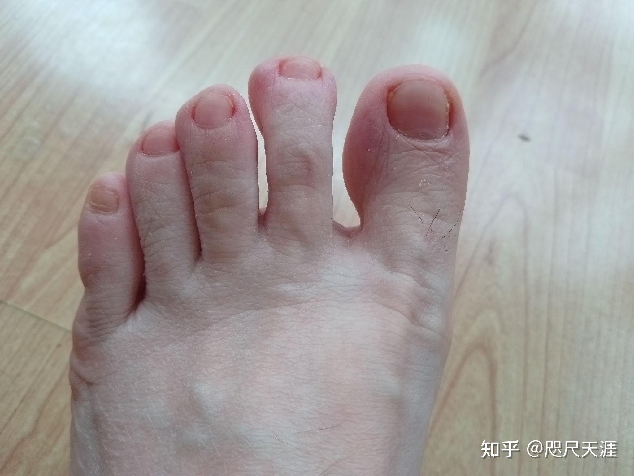 9-1    全脚8-22    全脚8-22     右脚8-22     左脚指甲有好转,妈妈