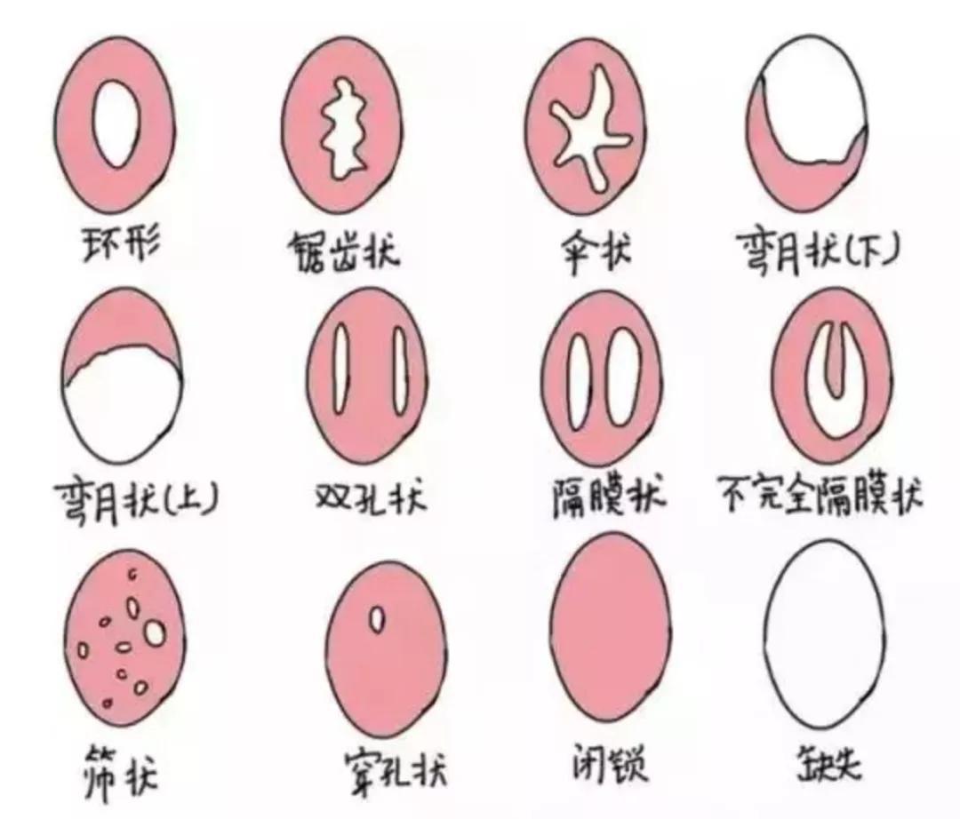 处女膜 如何查看处女膜？ - 知乎