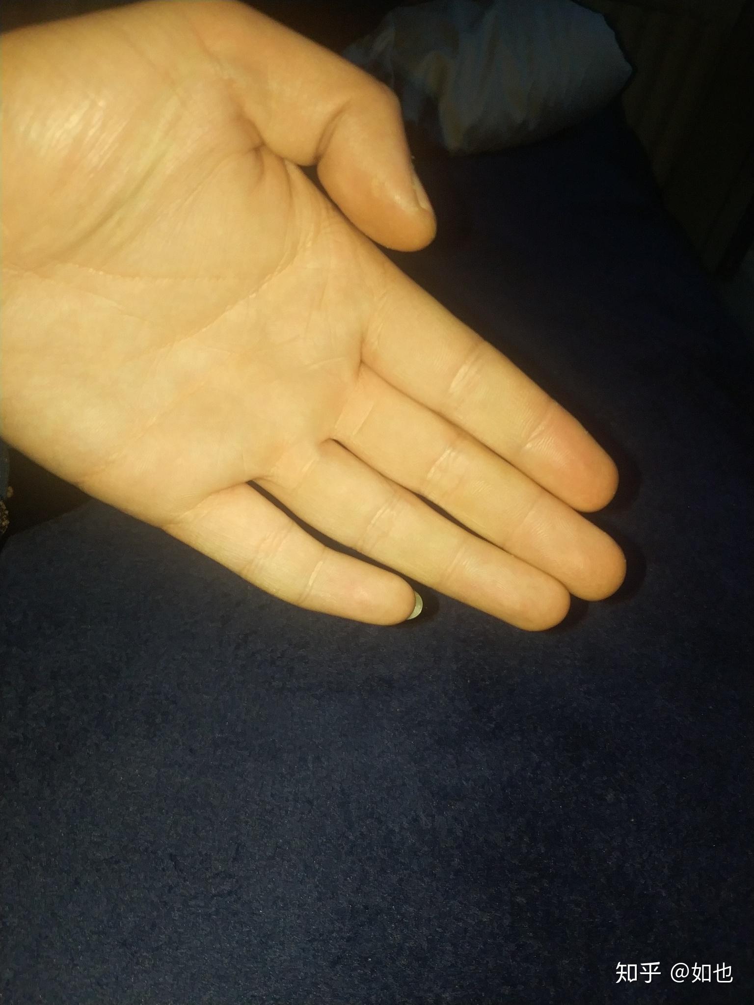 有没有天生小拇指向外弯曲的朋友? - 知乎