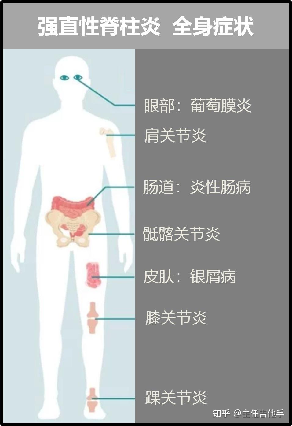 脊柱炎是什么症状图片