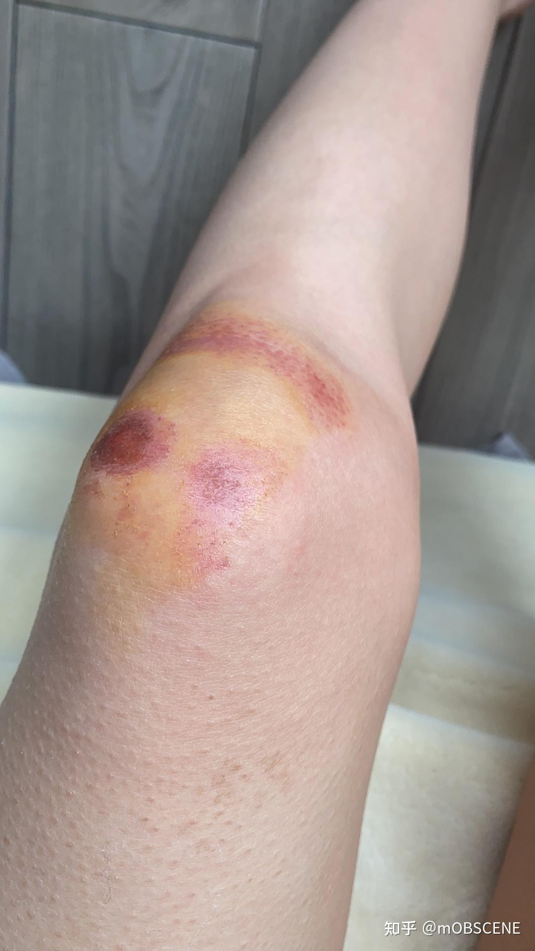 记录膝盖擦伤 - 知乎