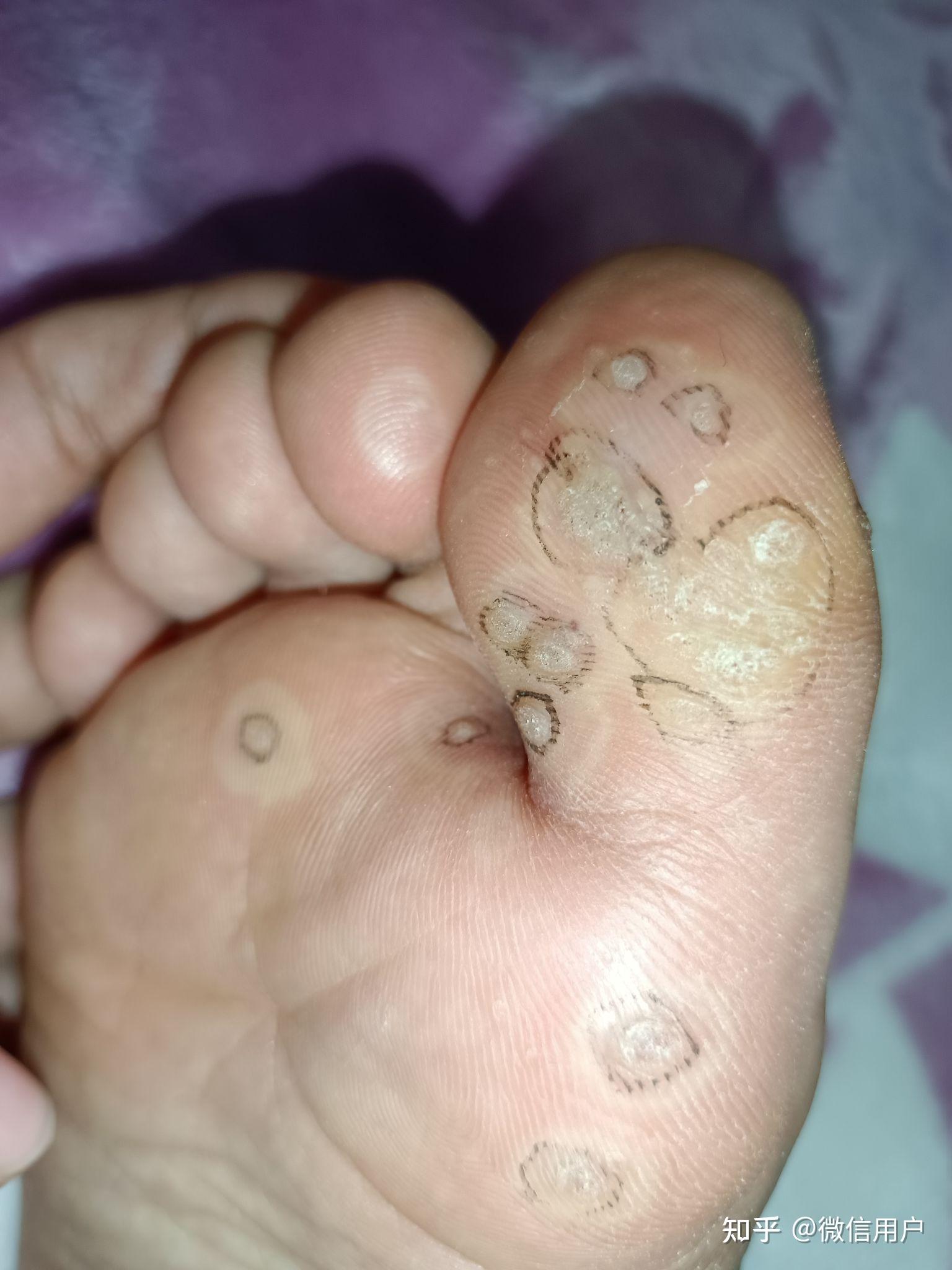 跖疣液氮冷冻恢复过程未完结