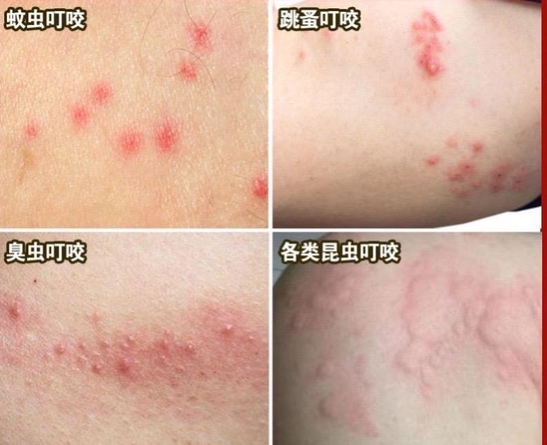 床上有一只跳蚤,宝宝又和我睡,不敢喷杀虫剂,洗澡换床单都赶不走它