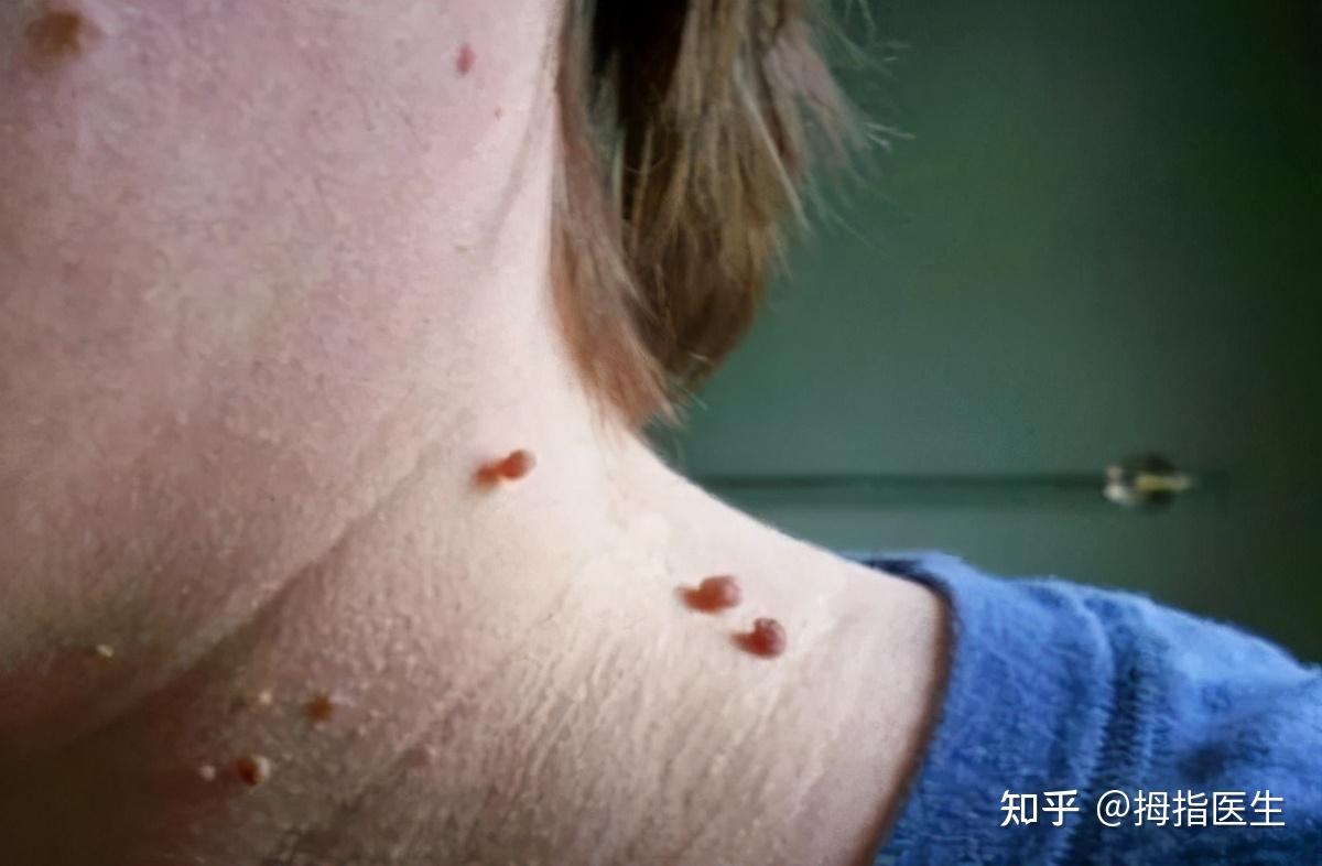 脖子上长了很多肉粒是恶性肿瘤吗