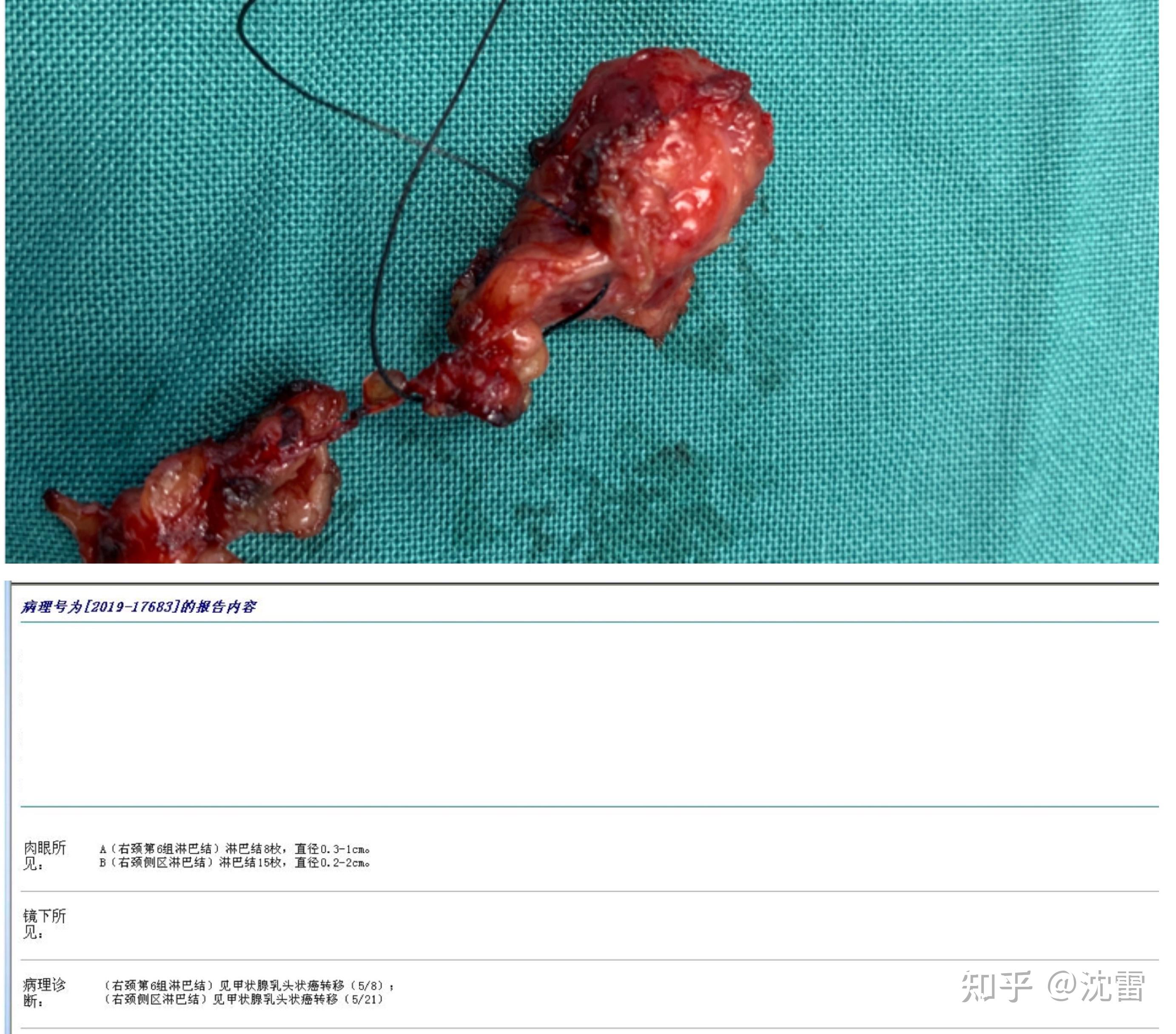 基于甲状腺手术双侧喉返神经损伤之解剖复习,临床应对