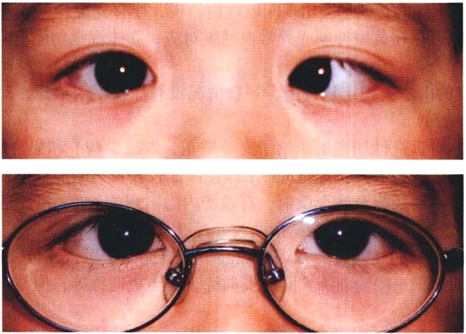 内隐斜视(不表现)人眼的调节与集合(双眼汇聚)存在一定的联动关系