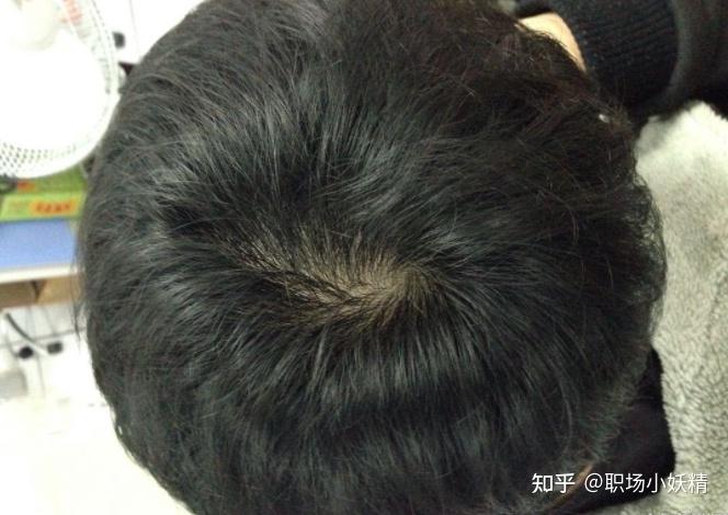 控油 去屑洗发水博乐达洗发水,它里面含有吡硫翁锌 超分子水杨酸,对