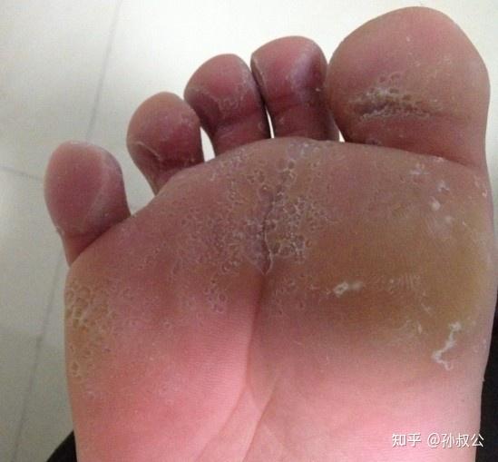 怎样才能摆脱脚上的真菌感染