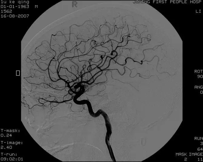 颈内动脉c6图片