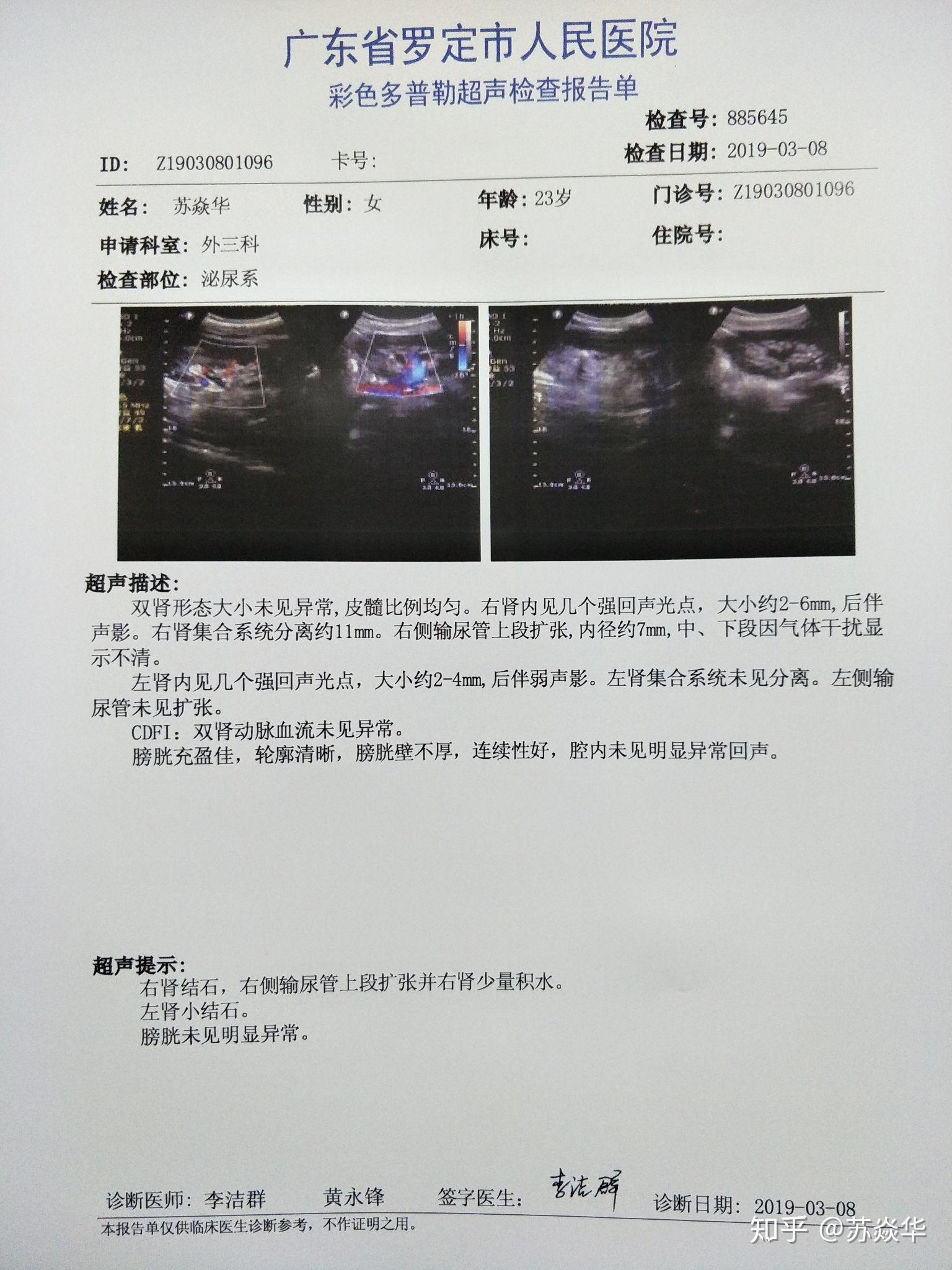 肾结石在左边还是右边图片