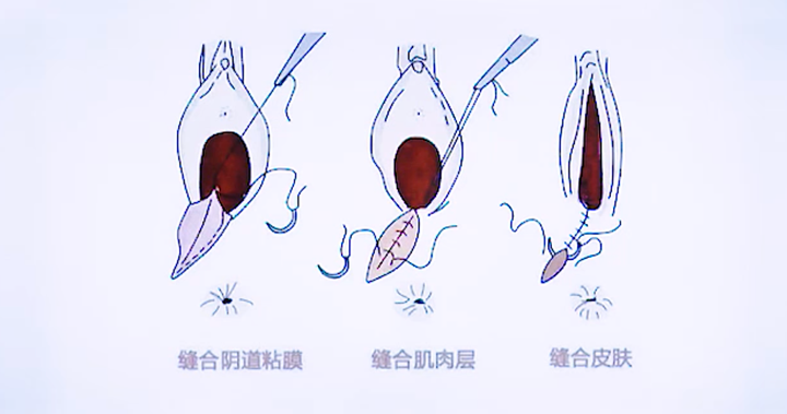 顺产撕裂 照片 自然图片