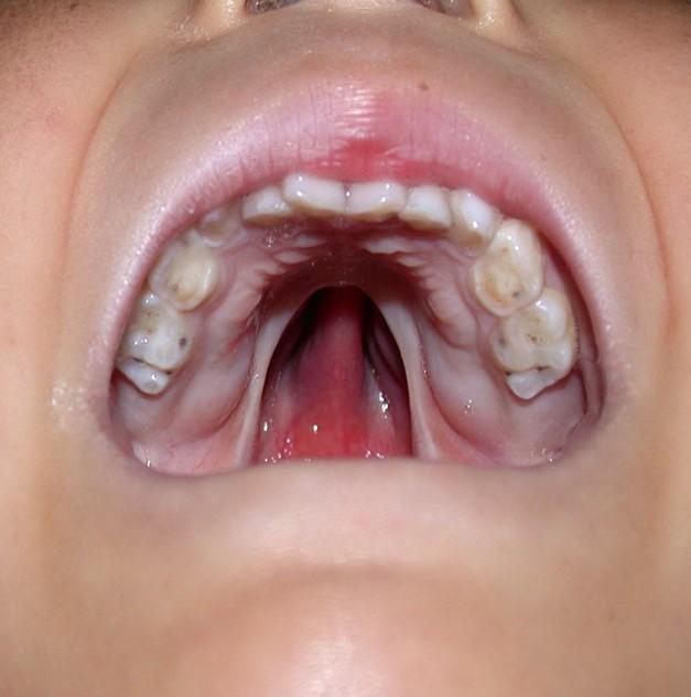 唇腭裂是什么?主要是什么原因导致的?