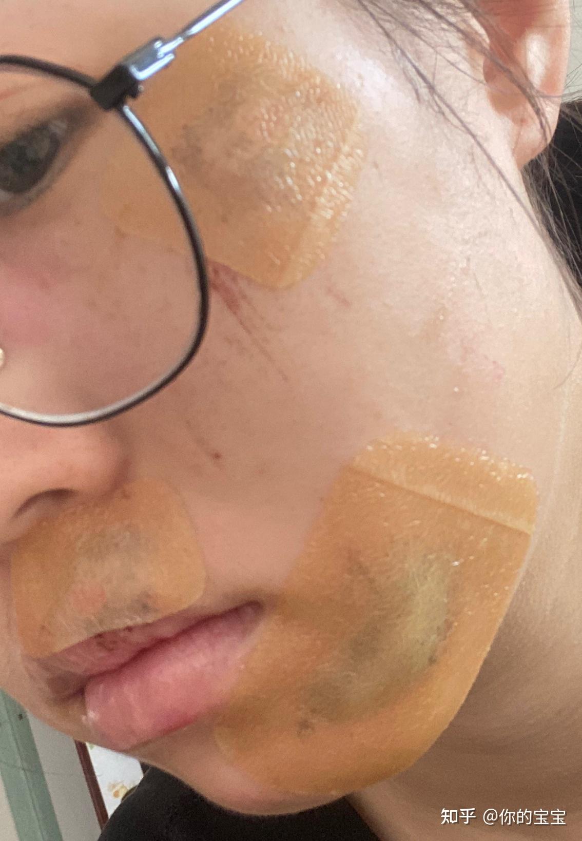脸部擦伤如图,请问如何恢复? - 知乎