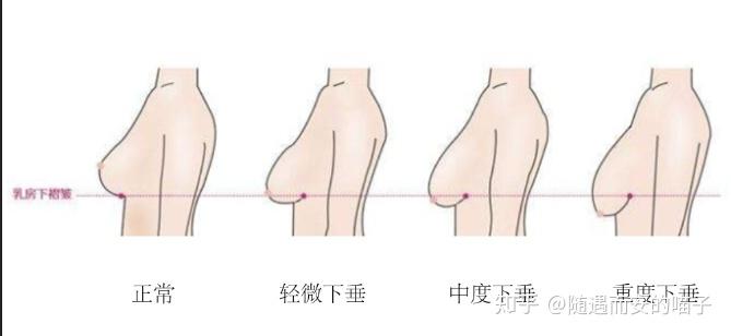 乳房假性下垂图片