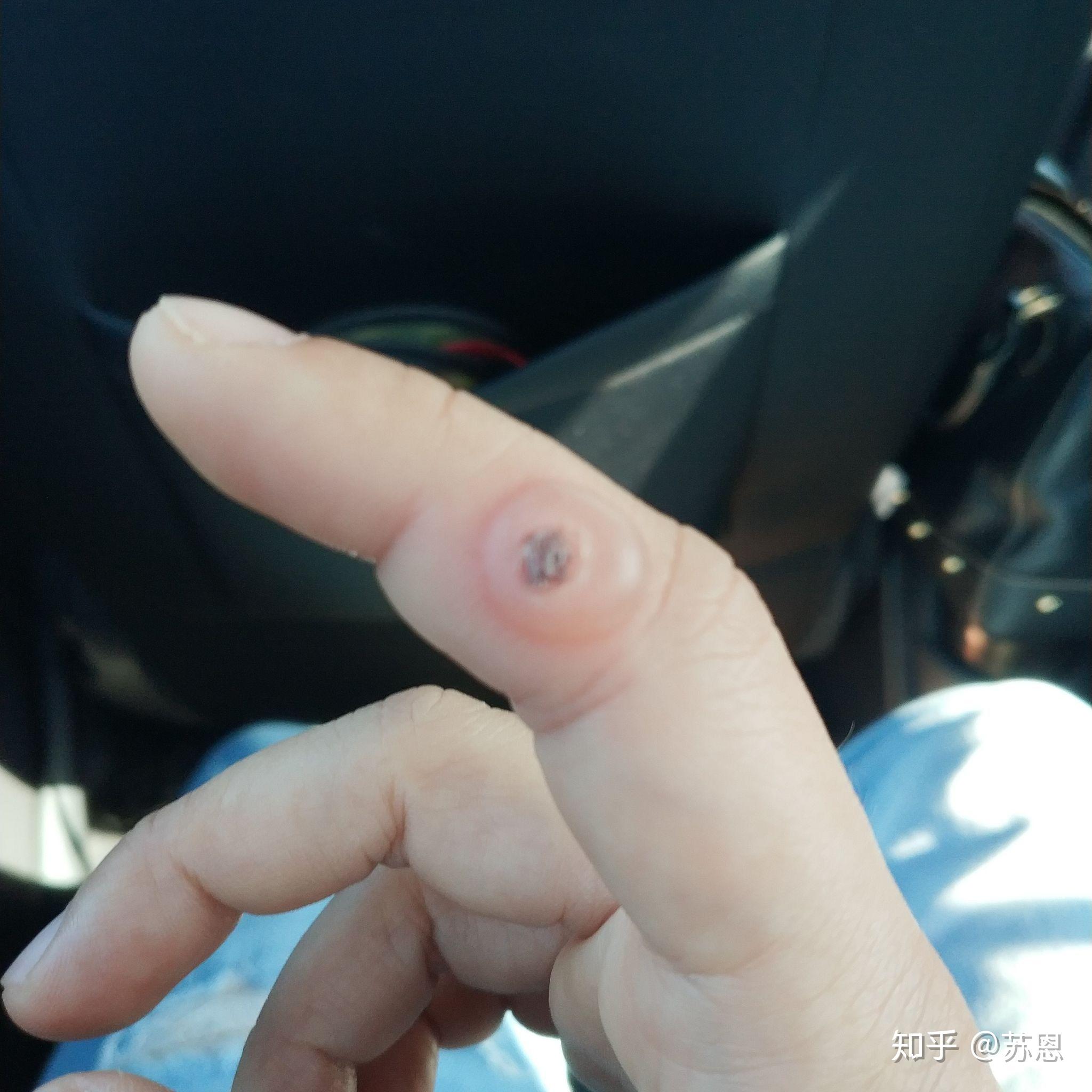 液氮冷冻治疗后手指上出了血泡而且越来越大该怎么办? - 知乎