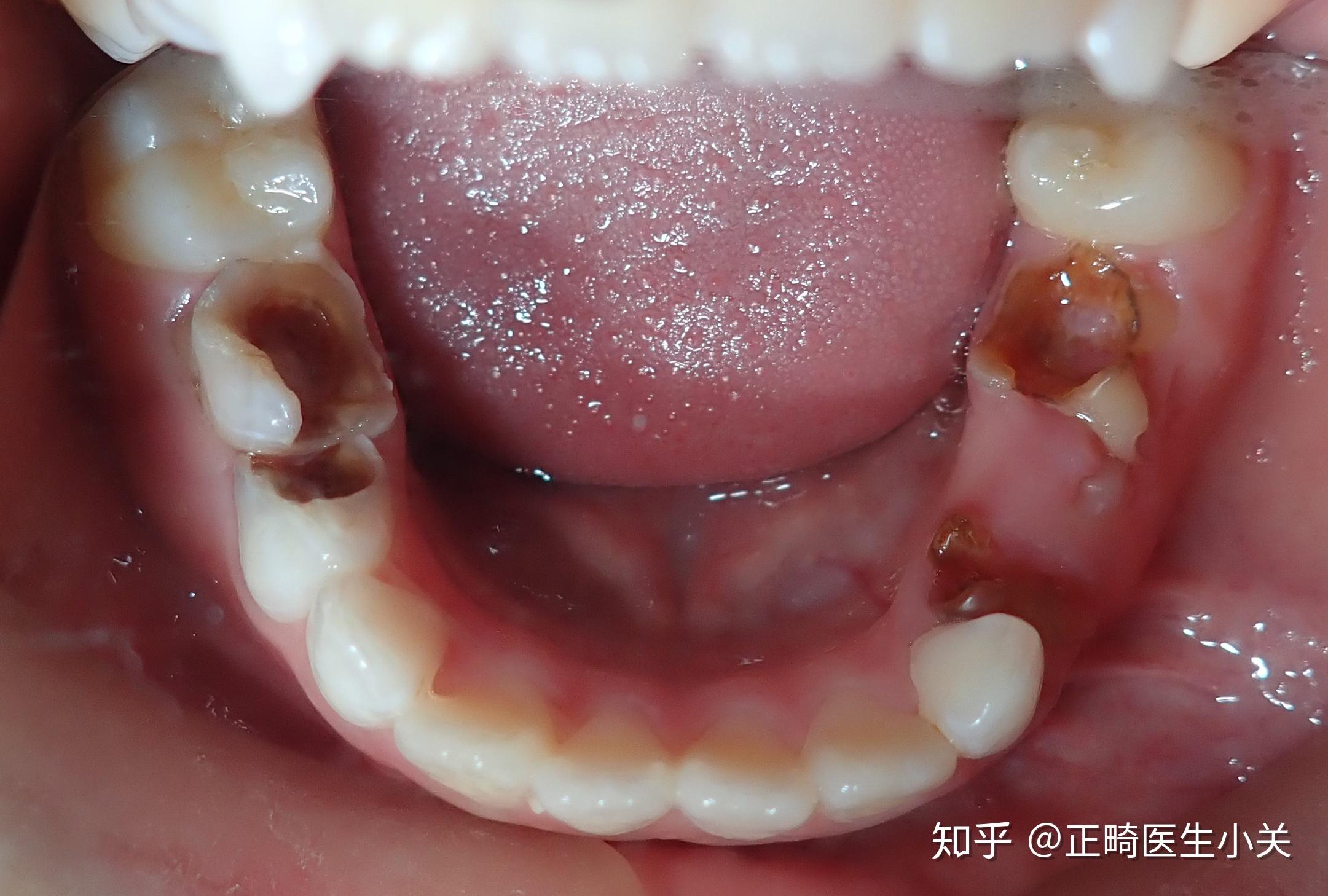 不良口腔习惯——偏侧咀嚼习惯 - 知乎