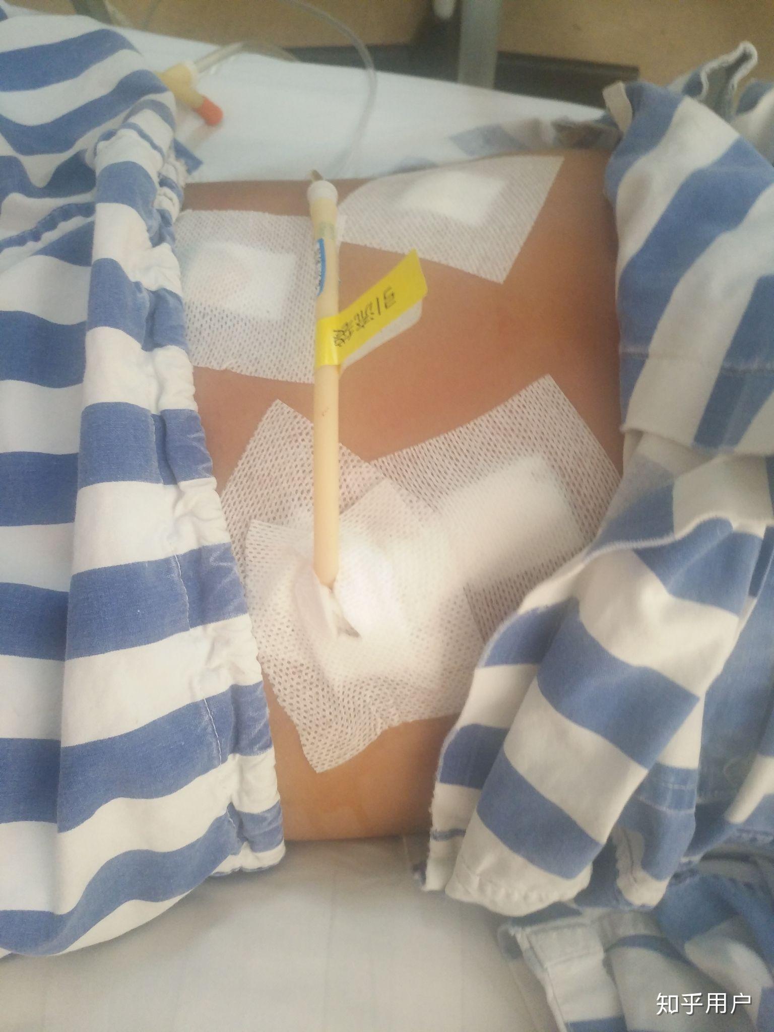 做完腹部手术什么感觉
