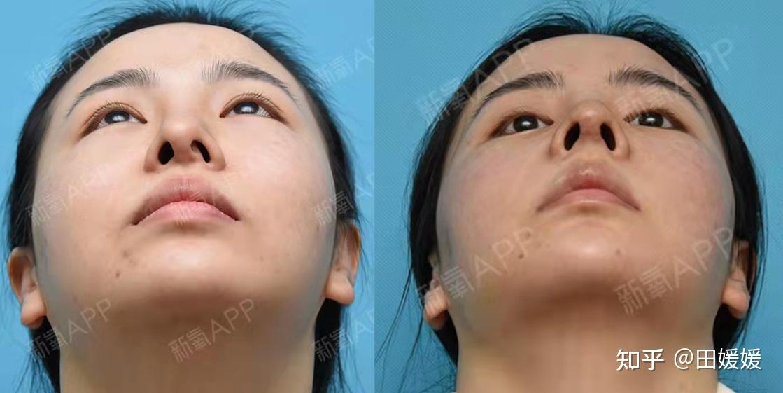 成都隆鼻哪里做的比较好?想要看起来比较自然的有没有推荐? - 知乎