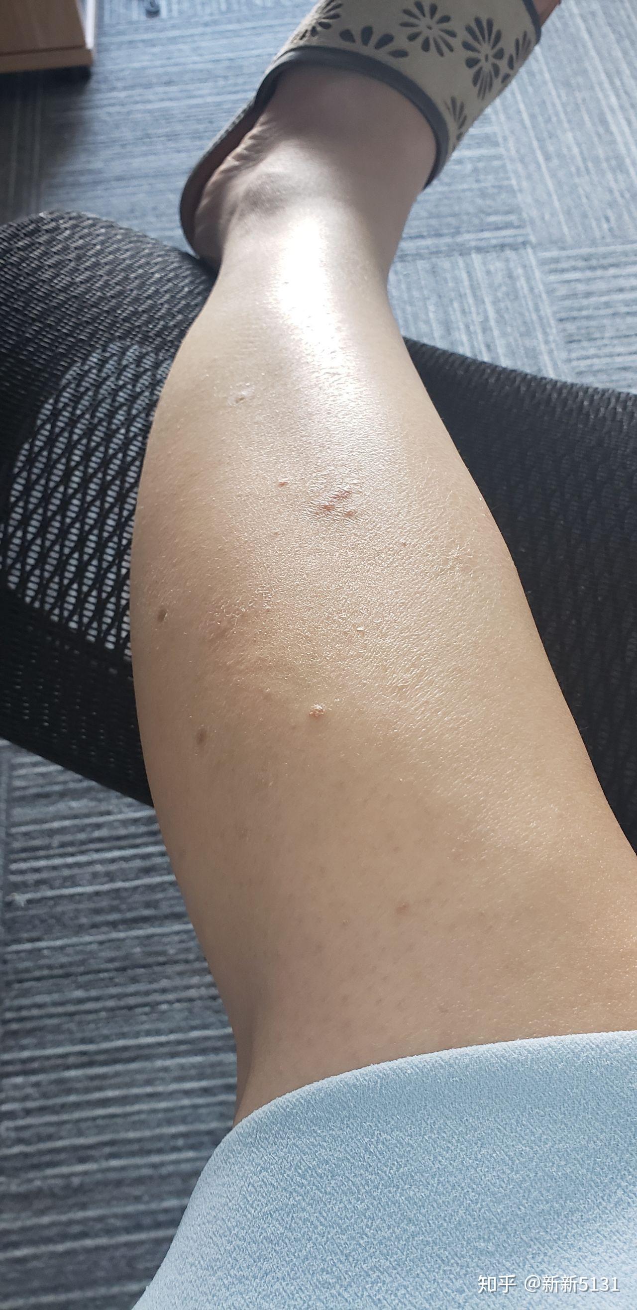 点滴型银屑病怎么破