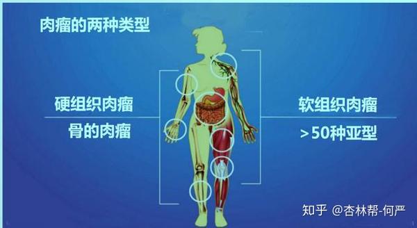 关于软组织肉瘤的常见问题 知乎