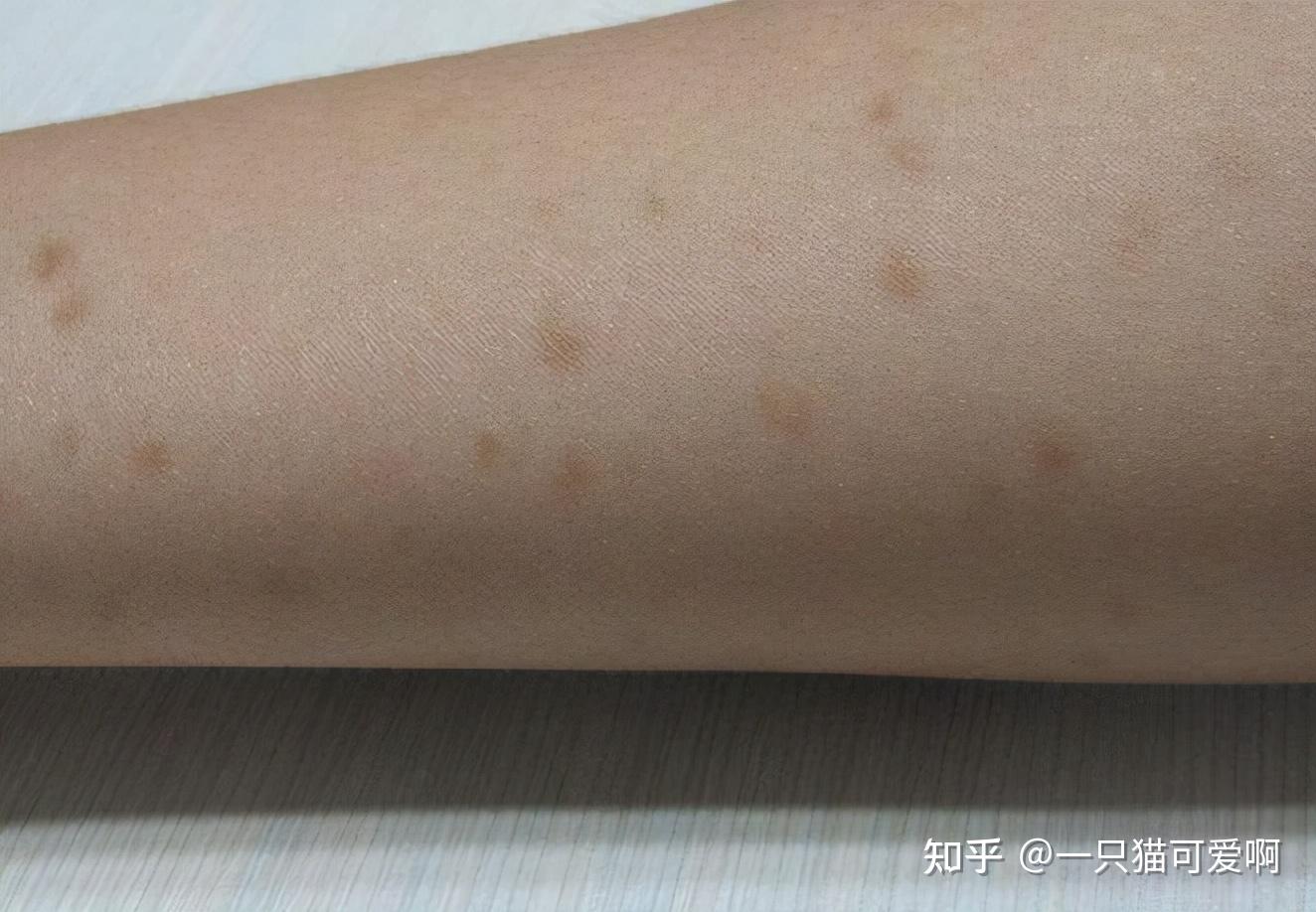 夫妻2人双双查出hpv医生身上有这疙瘩别大意快去检查