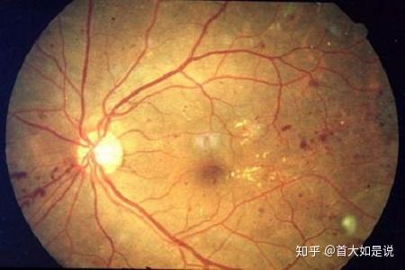 高血压性视网膜病变是因高血压病引起的眼底病变,由于高血压导致眼底