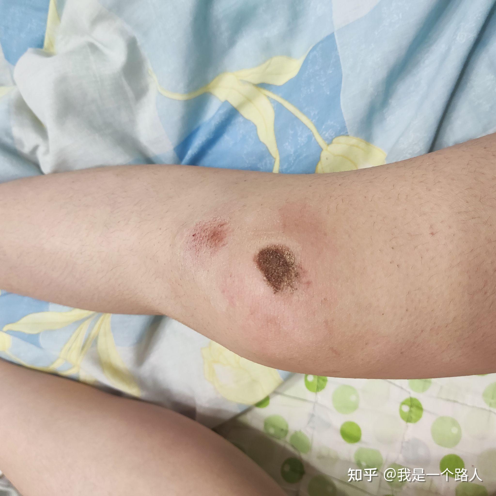 膝盖摔伤,抹了碘伏结痂后如何防止留疤? - 知乎