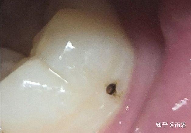 牙齿上有个小洞该不该补? - 知乎