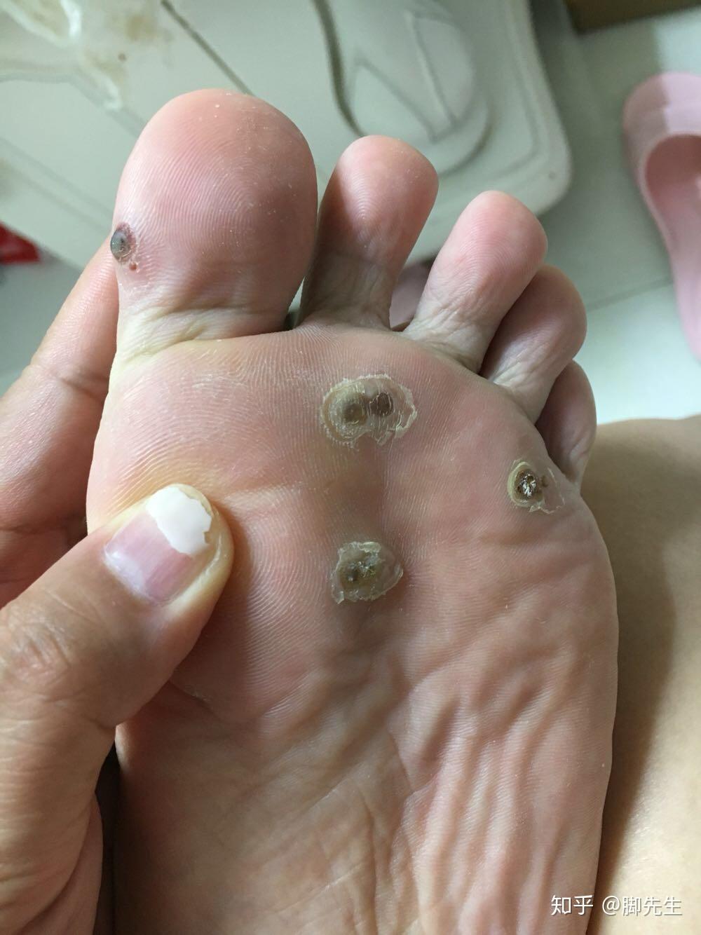 刚长出来的小跖疣怎么治? - 知乎