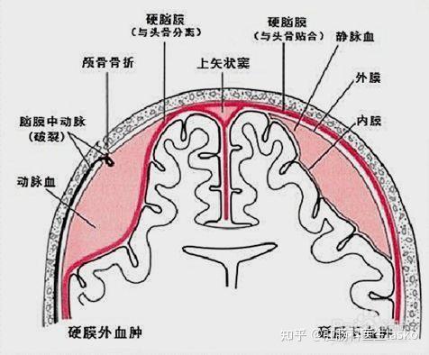 硬膜外血肿与硬膜下血肿鉴别
