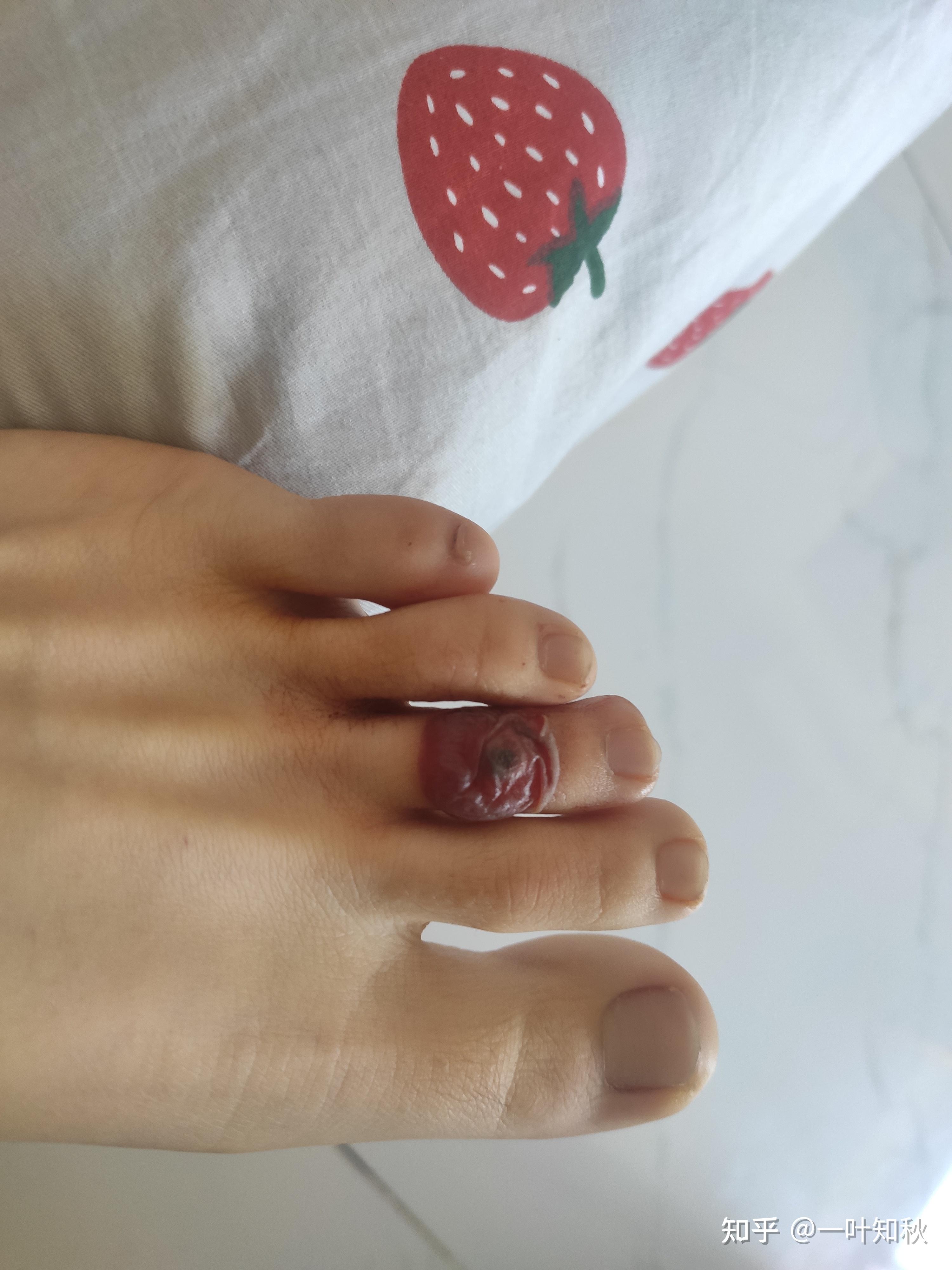 液氮冷冻治疗后手指上出了血泡而且越来越大该怎么办? - 知乎