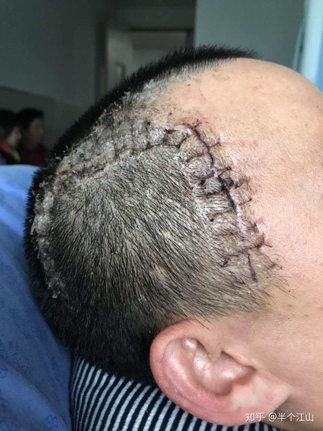 28岁脑出血,做了开颅手术,年轻人术后能恢复到什么程度? - 知乎