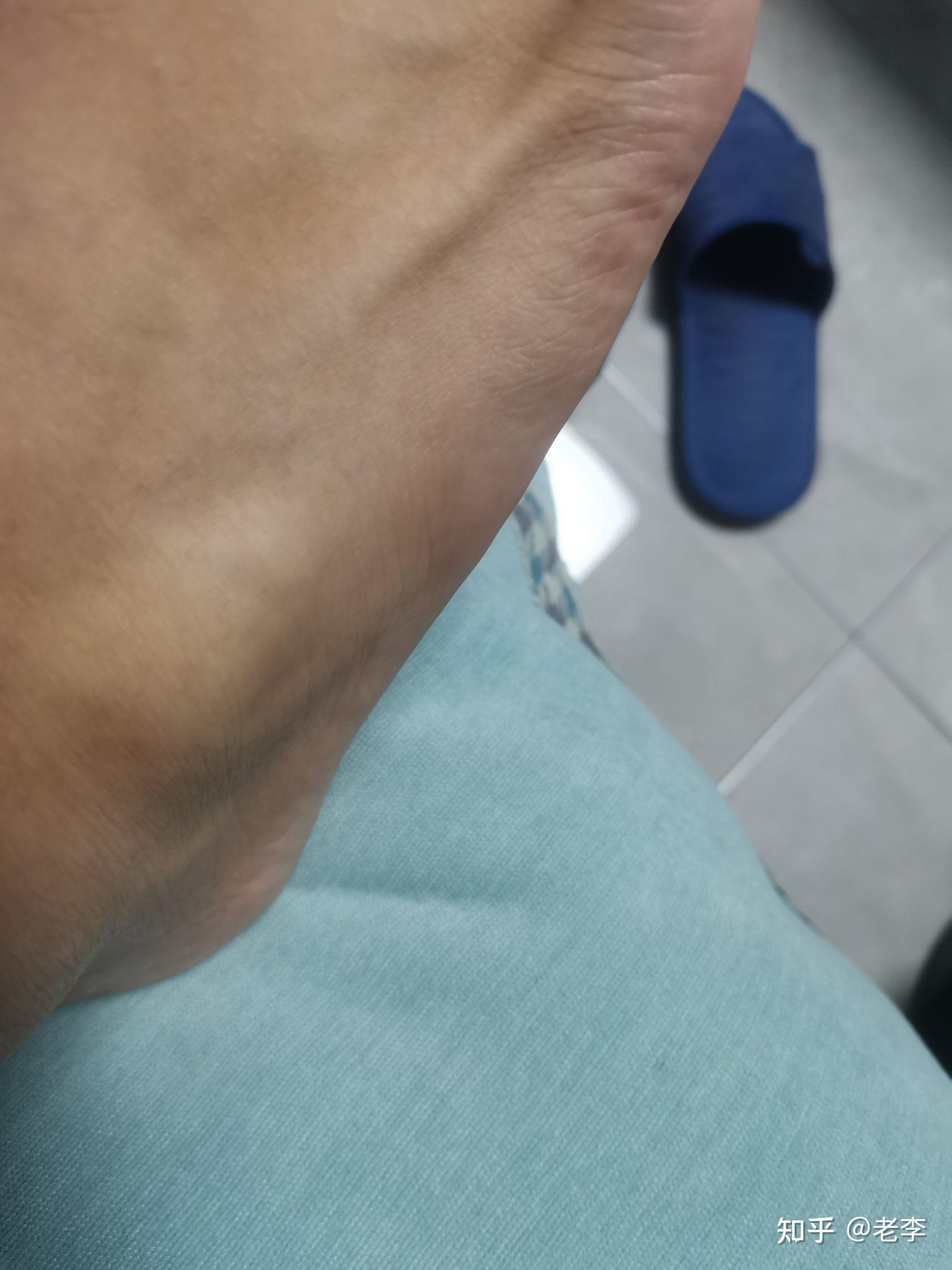 崴脚好久了,但是好了之后一直有个包,不痛不痒,运动也没妨碍,但是一直