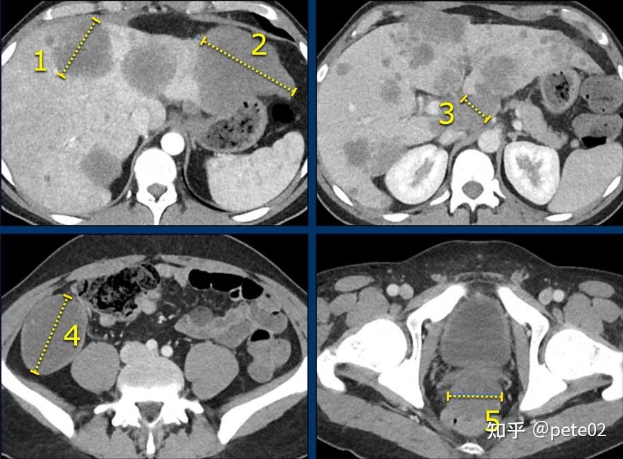 实体肿瘤疗效评价标准:recist 1.1 - 知乎