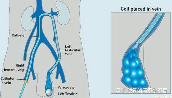 精索静脉曲张轻度图片